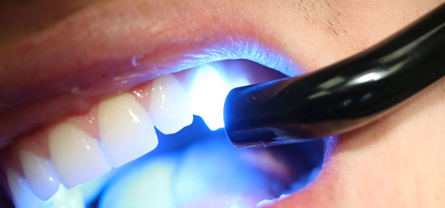 vancouver composite fillings