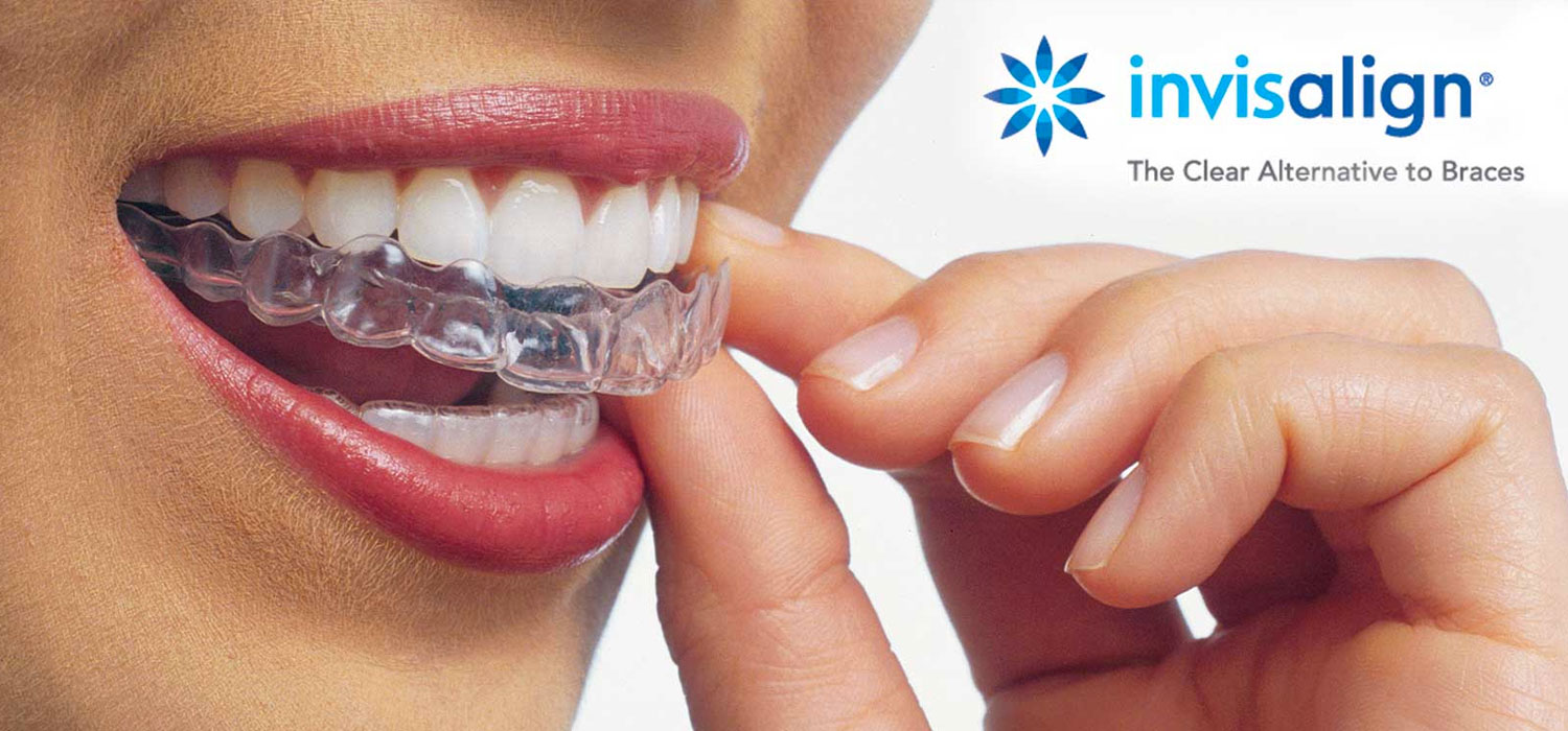 vancouver invisalign
