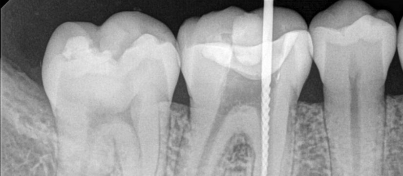 vancouver root canal