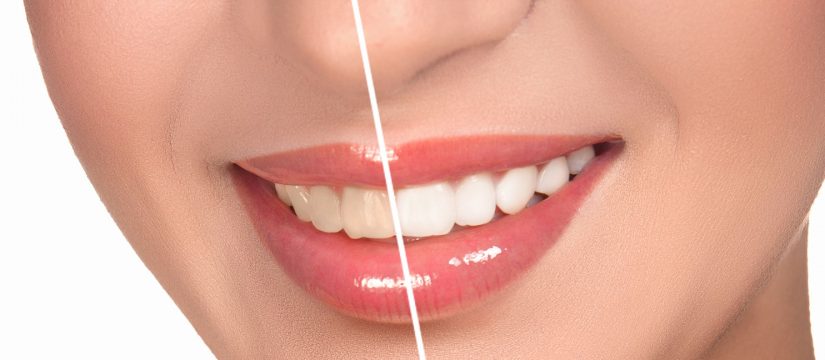 vancouver teeth whitening