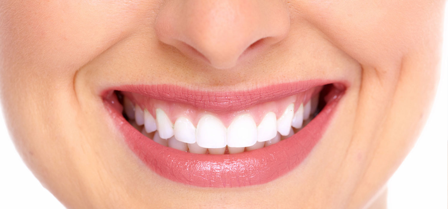 vancouver veneers